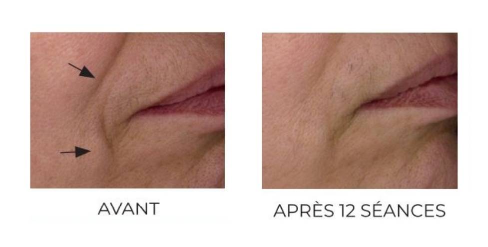 Résultats du visage avec le traitement LPG Cellu M6 Alliance© Lyon 6 
