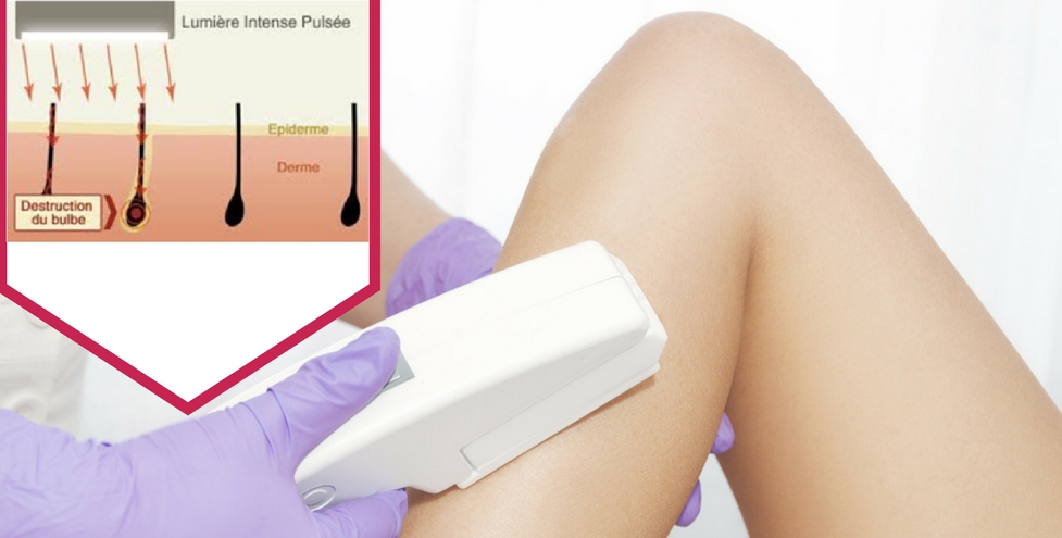 JAMBES ENTIÈRES - IPL - EPILATION LUMIERE PULSEE